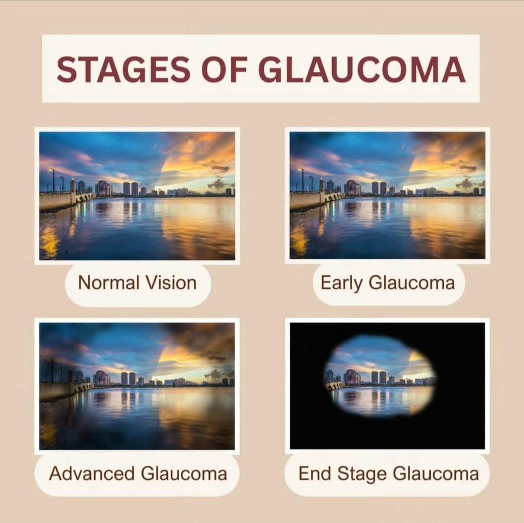 Glaucoma